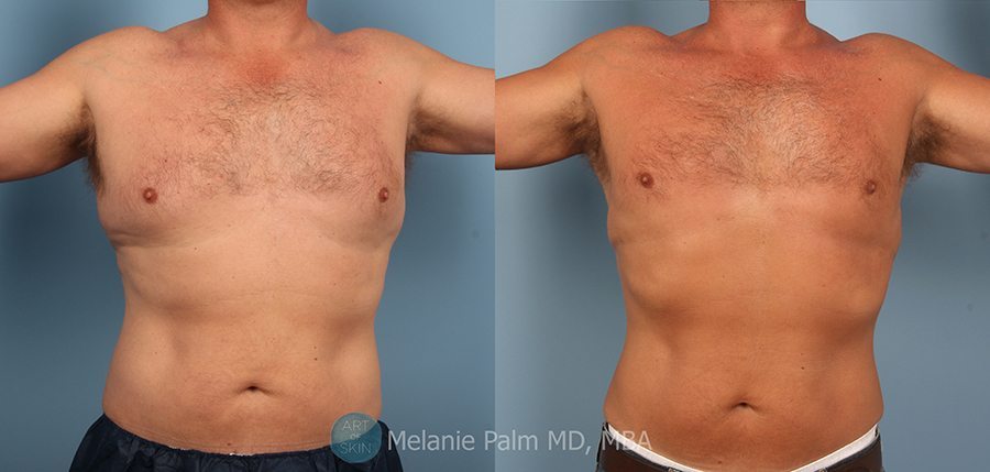 male chest reduction Ludhiana