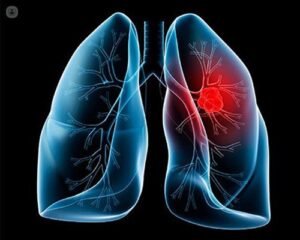 oncologists in chennai for lung cancer