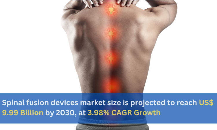 Spinal fusion devices market size is projected to reach US 9.99 Billion by 2030 at 3.98 CAGR Growth – Renub Research WingsMyPost