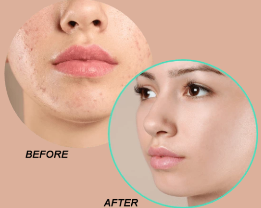 How Do You Get Rid Of Acne Easily And Fast?