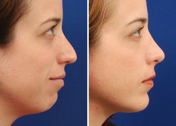 chin augmentation