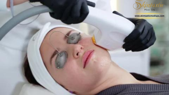 photofacial IPL in Riverside