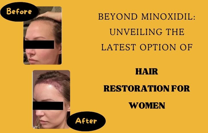 Beyond-Minoxidil-Unveiling-the-Latest-Option-of-Hair-Restoration-for-Women