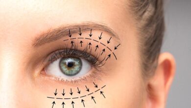A Step-by-Step Guide to Blepharoplasty Surgery in Dubai