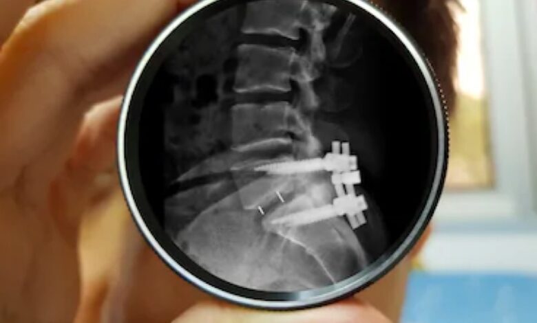 spine fracture treatment