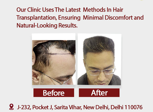 hair transplant