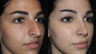 Rhinoplasty in Dubai: Transform Your Appearance with Expert Care