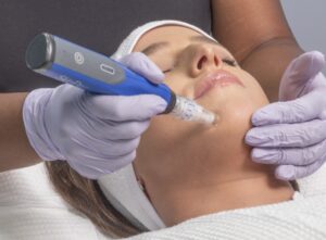 SkinPen Microneedling