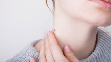 skin tag removal Sydney