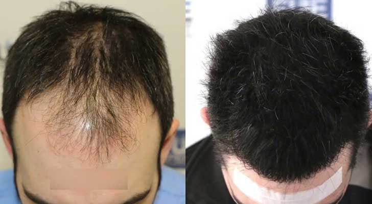 hair loss treatment in Delhi