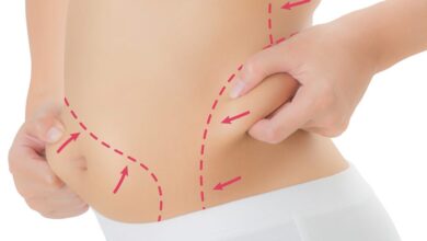 Liposuction WingsMyPost