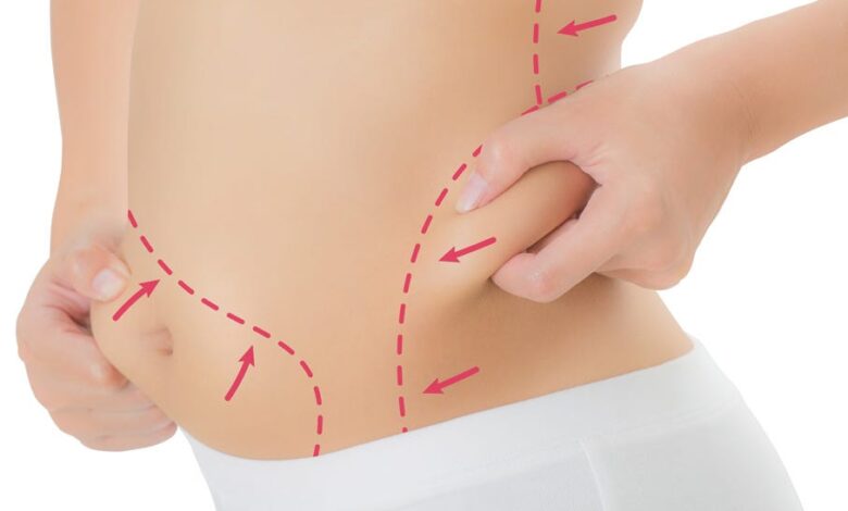 Liposuction WingsMyPost