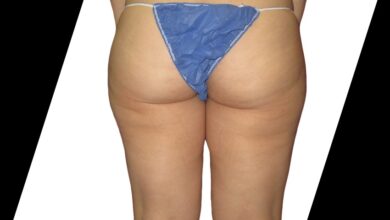 Liposuction Houston