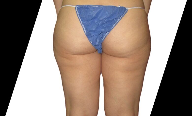 Liposuction Houston