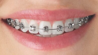 Orthodontic Treatment